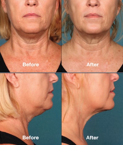 Kybella3