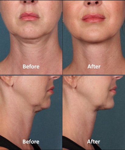 Kybella4