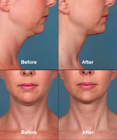 Kybella6