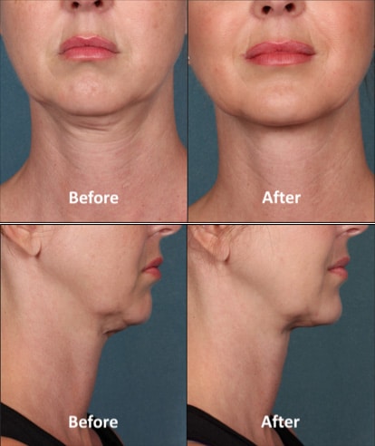 Kybella7