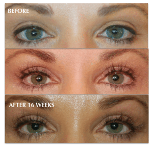 Wells Card Before After LATISSE1 300x288 1