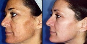 Wells Card Before After Radiesse Microdermabrasion1 300x152 1