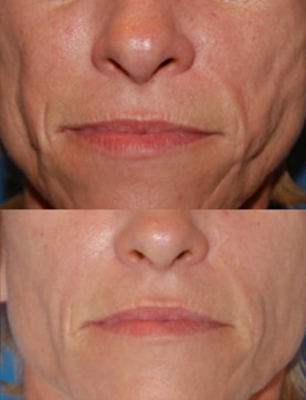 Wells Card Before After Radiesse Microdermabrasion2