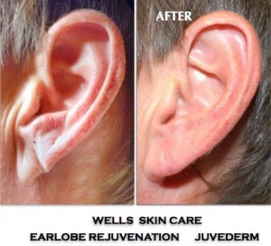 ear lobe rejuvenation with juvederm 5e9577f8a1f50