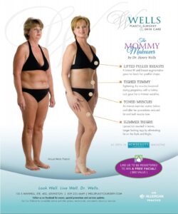 our patients story this month features maries mommy makeover 5e9577e4604c7