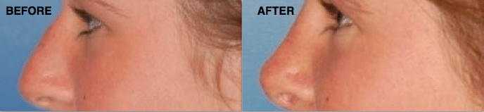 rhinoplasty corrects shape size of the nose 5e9577c6f1cce