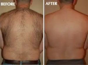 Laser Hair Reduction Before and After