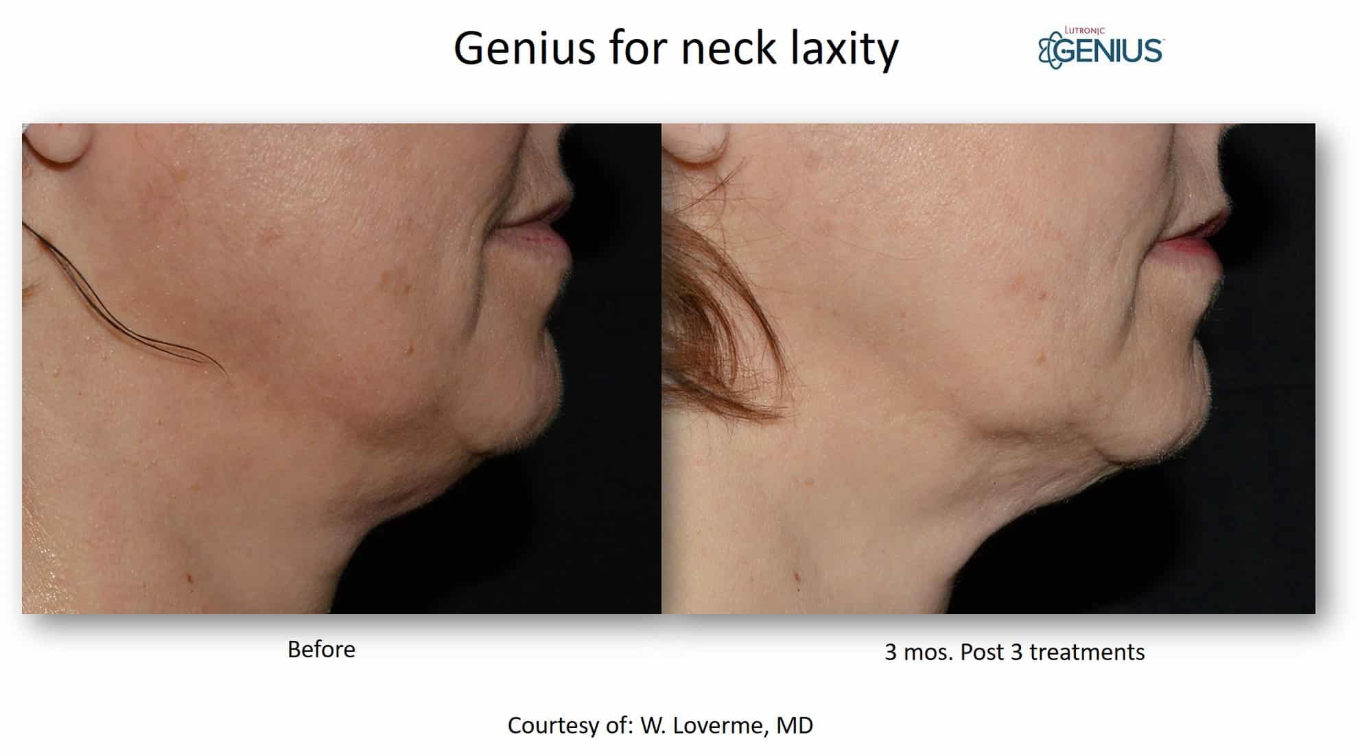 Genius LoVerme Neck Laxity