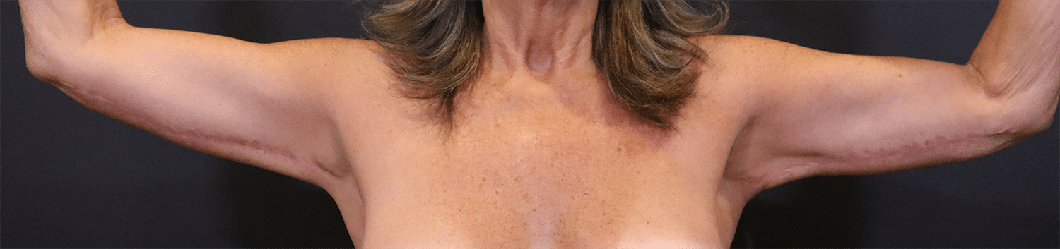 After Image: Brachioplasty - front
