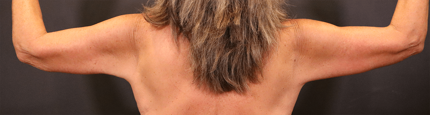 After Image: Brachioplasty - back