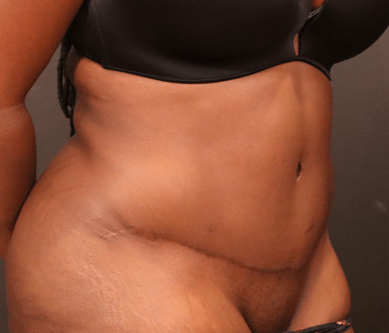 After Image: Abdominoplasty - right-front-oblique