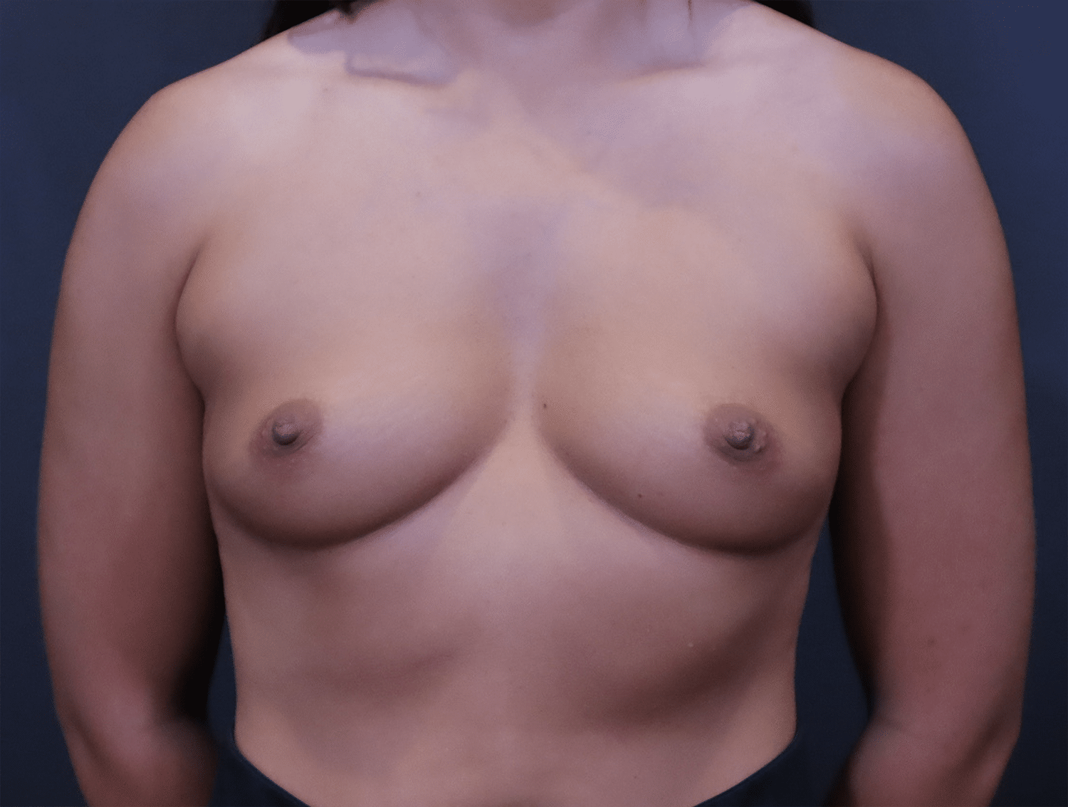 Before Image: Breast Augmentation - front