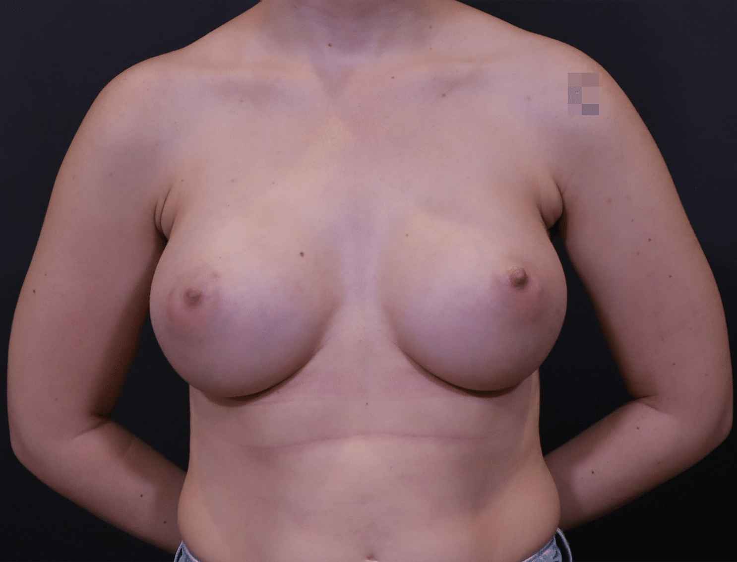 After Image: Breast Augmentation - front