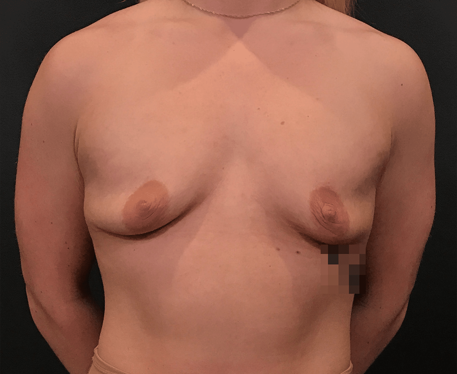 Before Image: Breast Augmentation - front