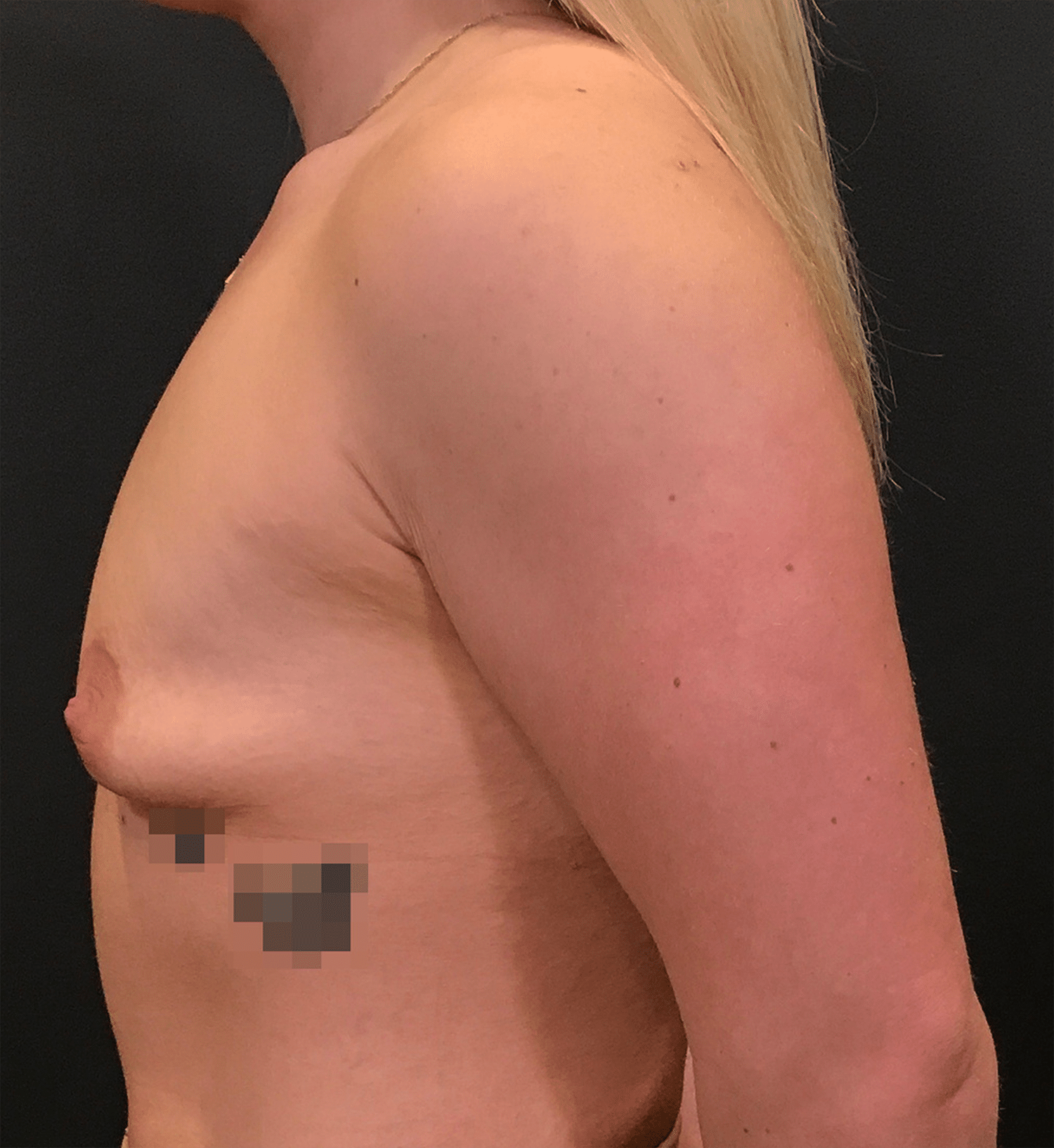 Before Image: Breast Augmentation - left-side