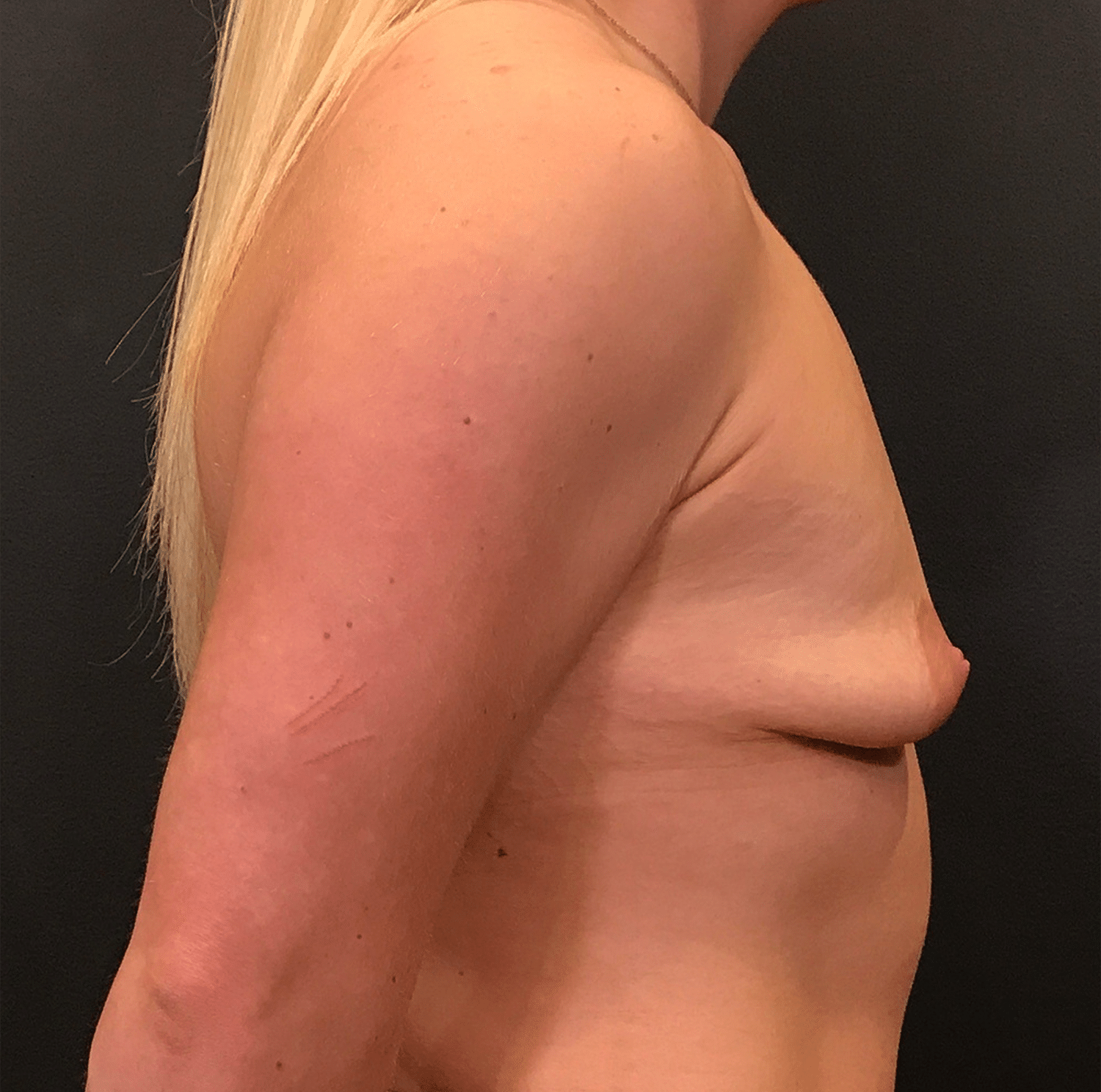Before Image: Breast Augmentation - right-side