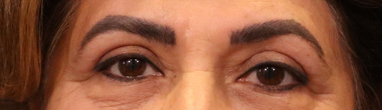 After Image: Blepharoplasty - front