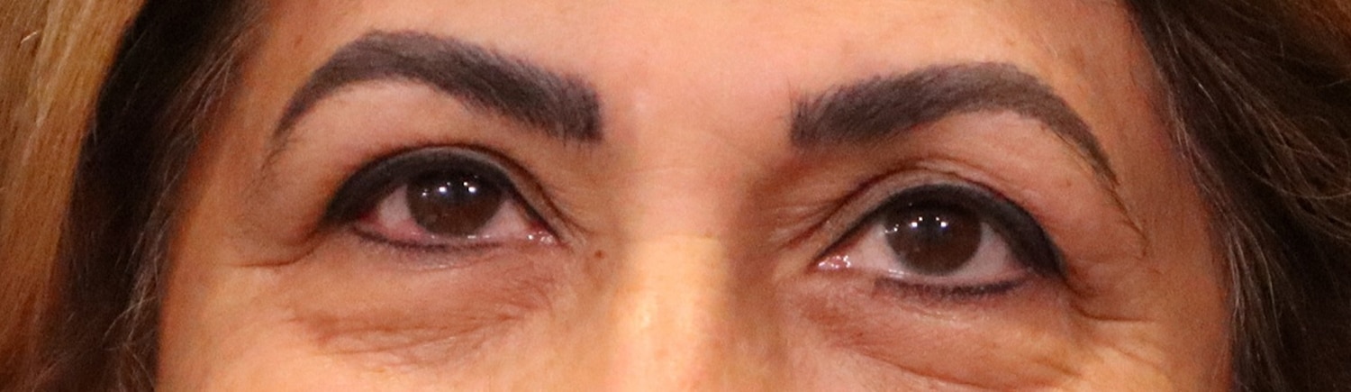 Before Image: Blepharoplasty - front