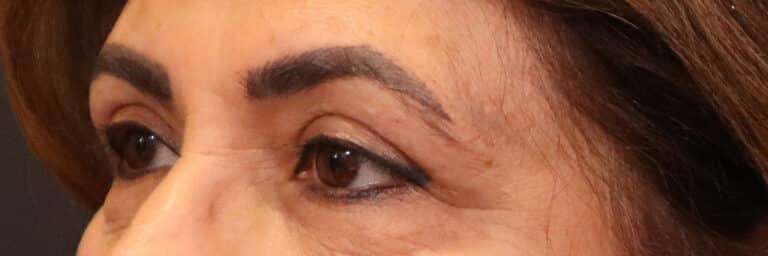 After Image: Blepharoplasty - left-front-oblique