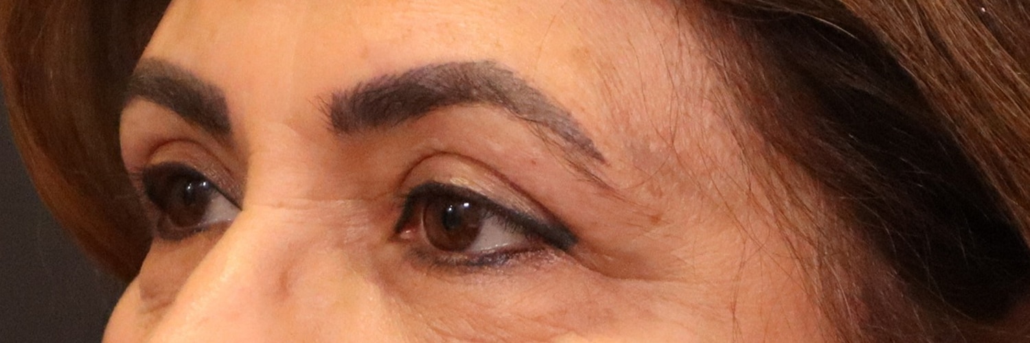 After Image: Blepharoplasty - left-front-oblique