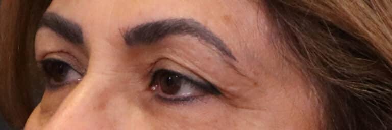Before Image: Blepharoplasty - left-front-oblique