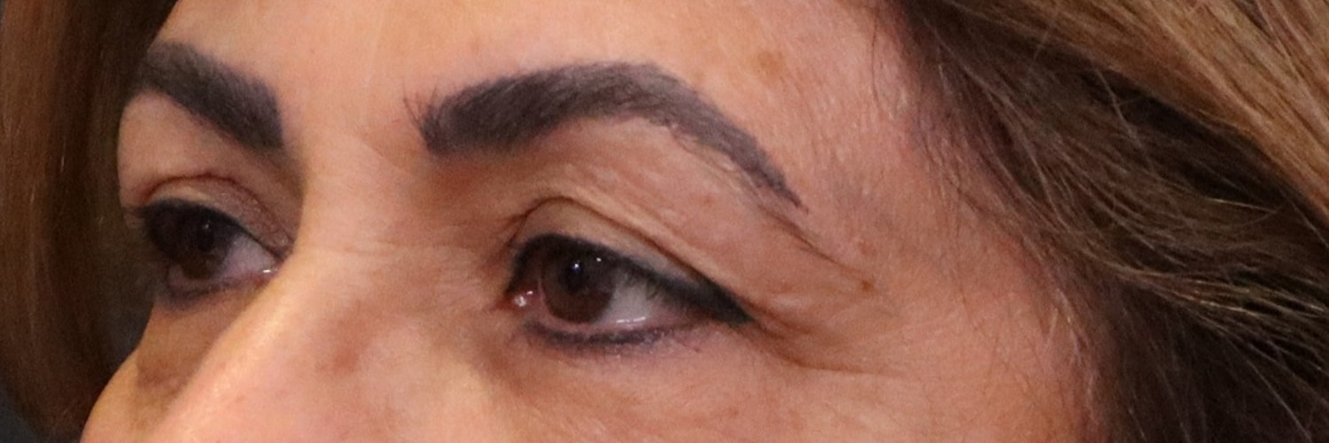 Before Image: Blepharoplasty - left-front-oblique