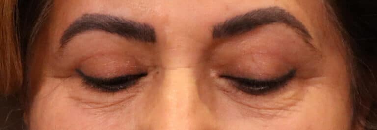 After Image: Blepharoplasty - front