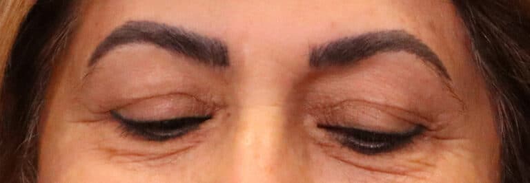 Before Image: Blepharoplasty - front
