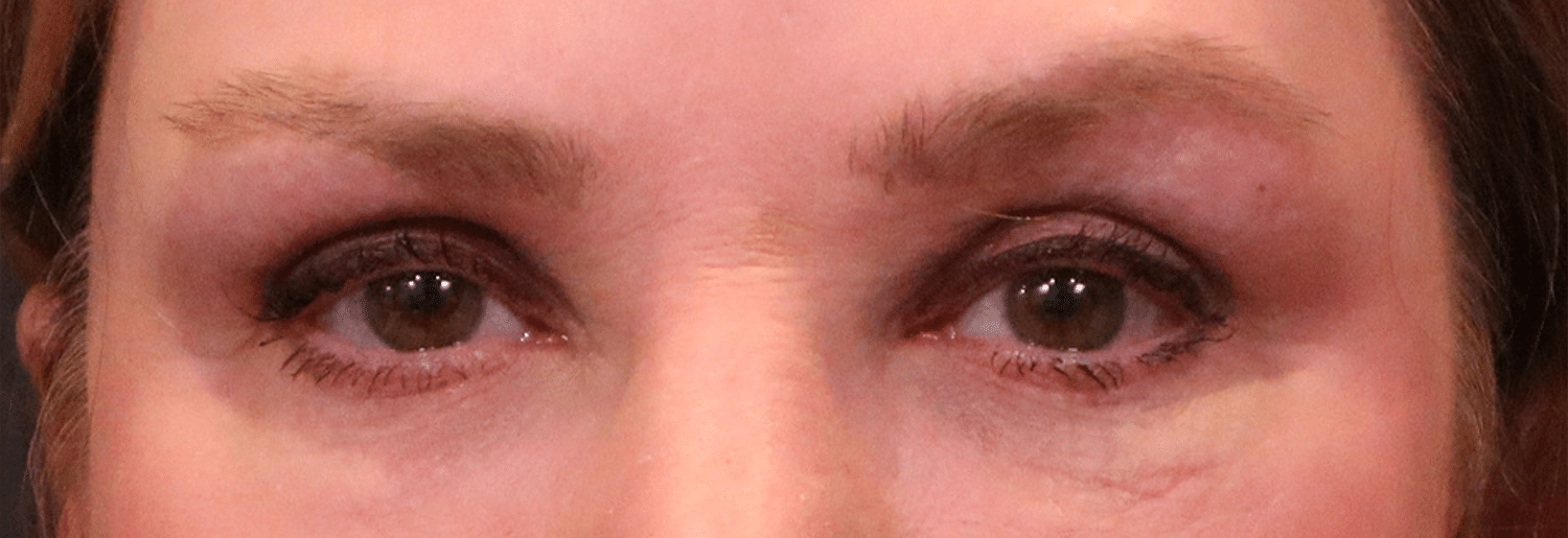 After Image: Blepharoplasty - front