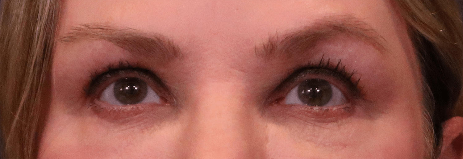 Before Image: Blepharoplasty - front