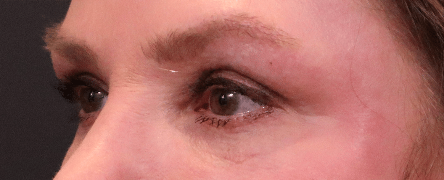 After Image: Blepharoplasty - left-front-oblique
