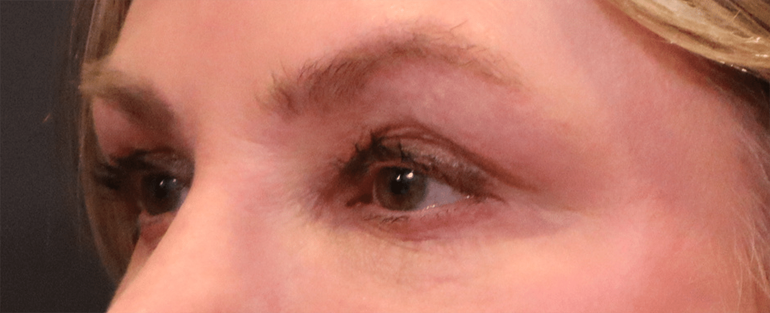 Before Image: Blepharoplasty - left-front-oblique