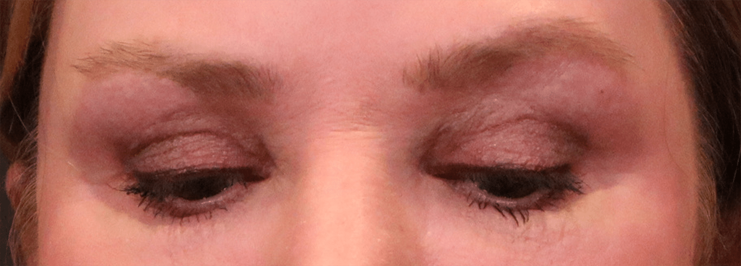 After Image: Blepharoplasty - front