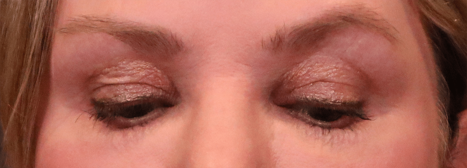 Before Image: Blepharoplasty - front