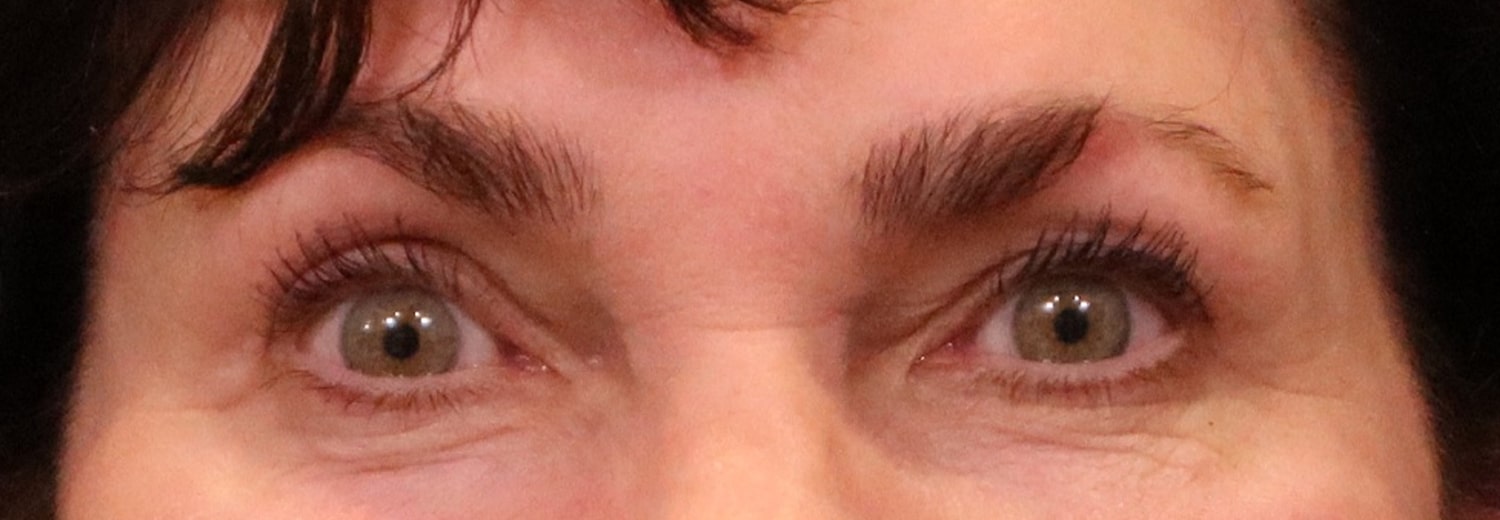 After Image: Blepharoplasty - front