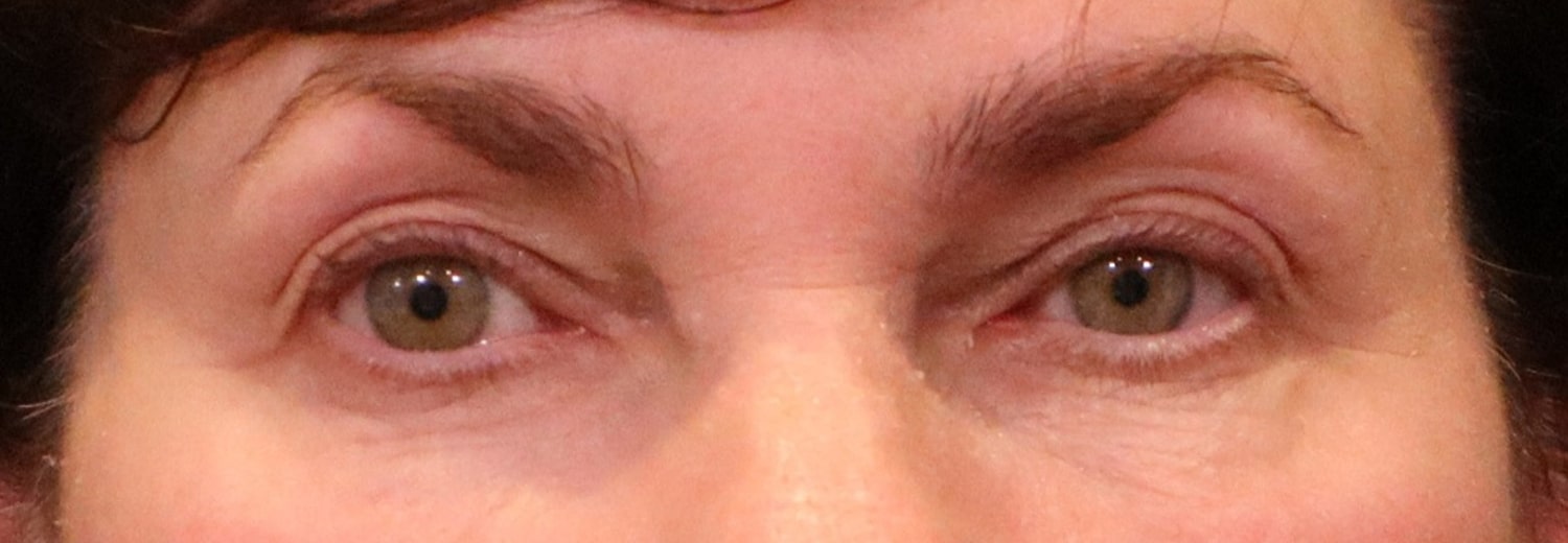Before Image: Blepharoplasty - front