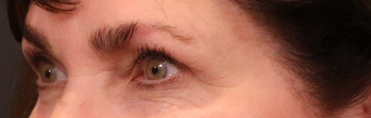 After Image: Blepharoplasty - left-front-oblique