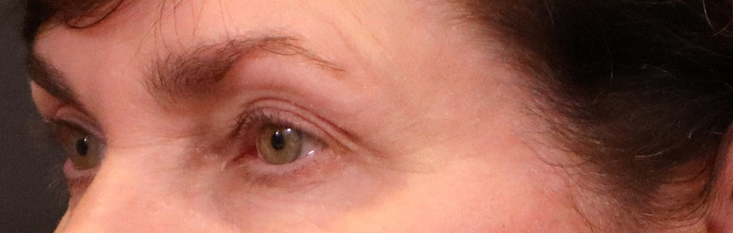 Before Image: Blepharoplasty - left-front-oblique