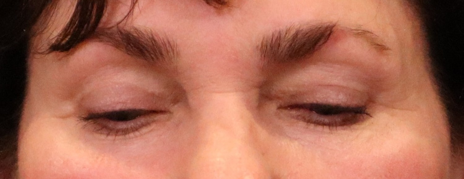 After Image: Blepharoplasty - front