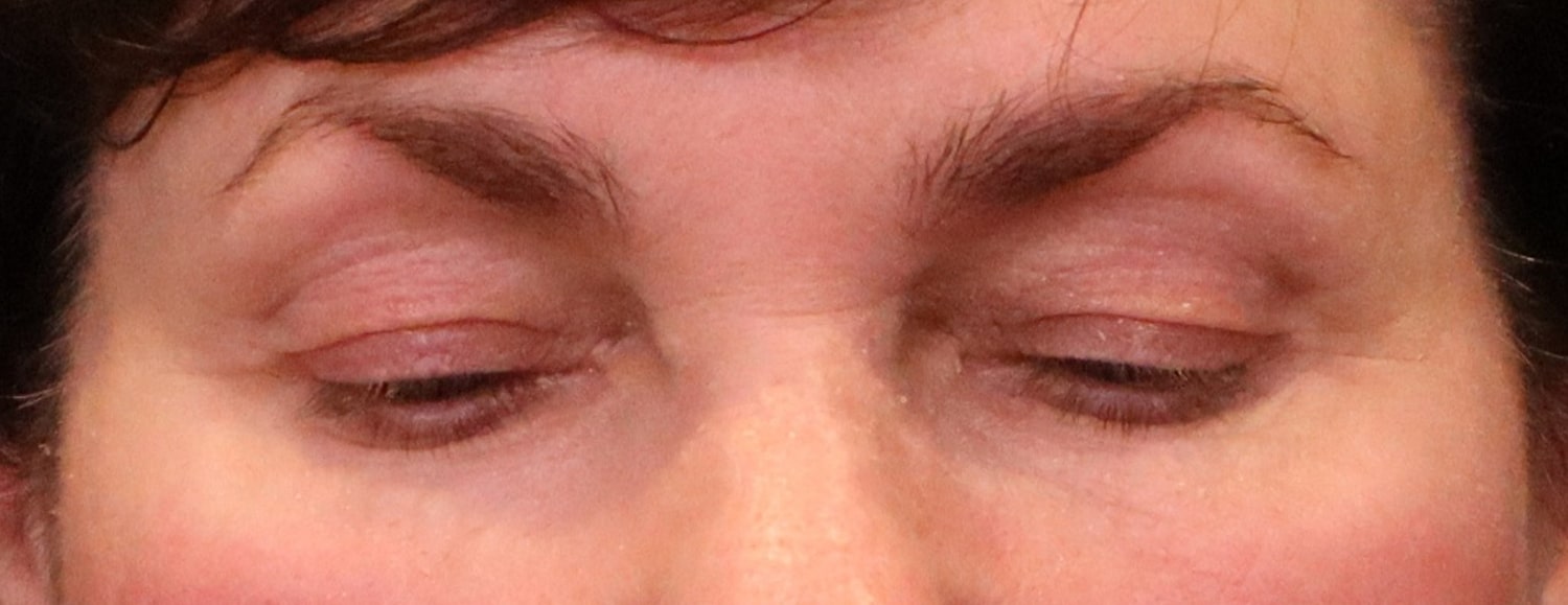 Before Image: Blepharoplasty - front