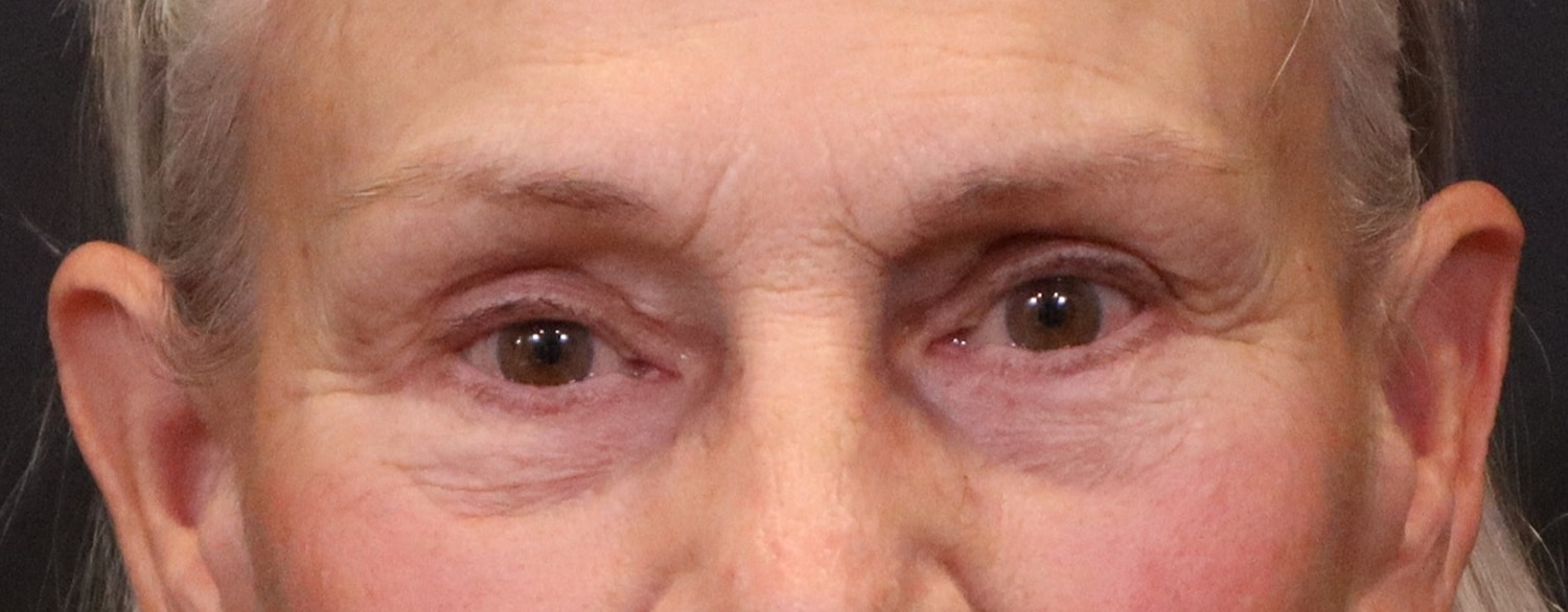 After Image: Blepharoplasty - front