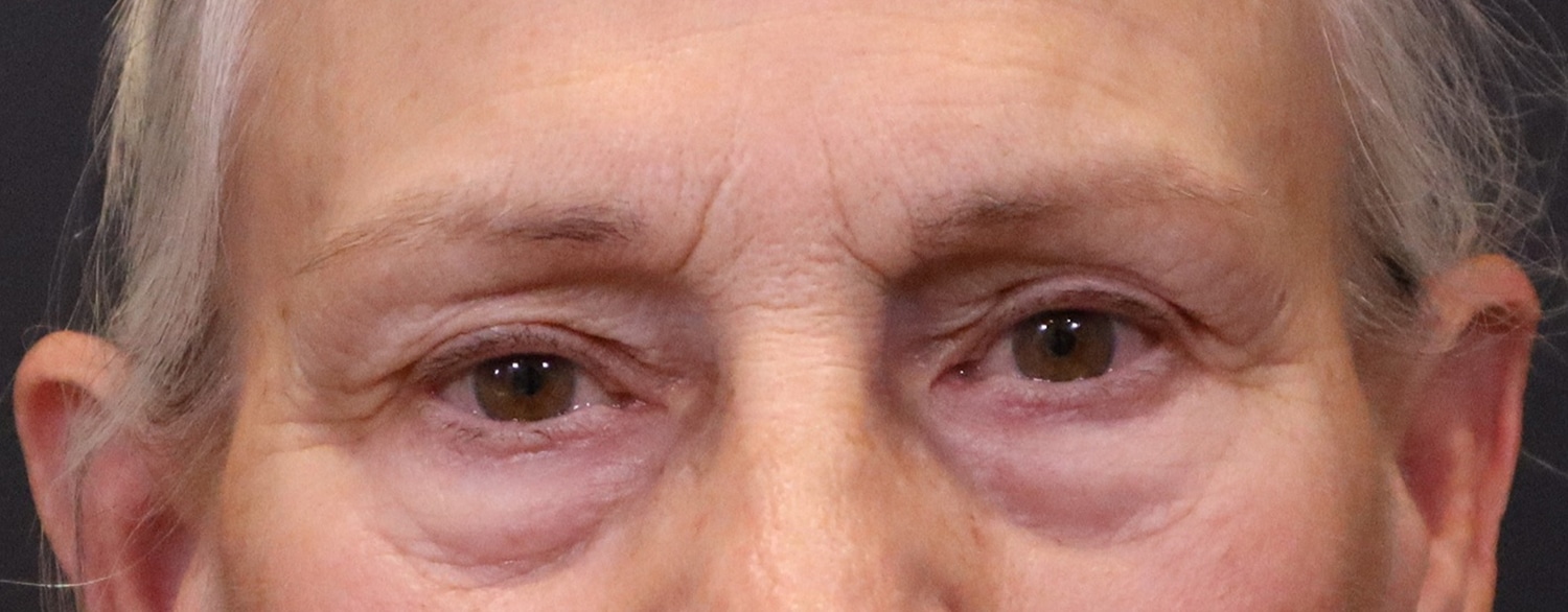 Before Image: Blepharoplasty - front