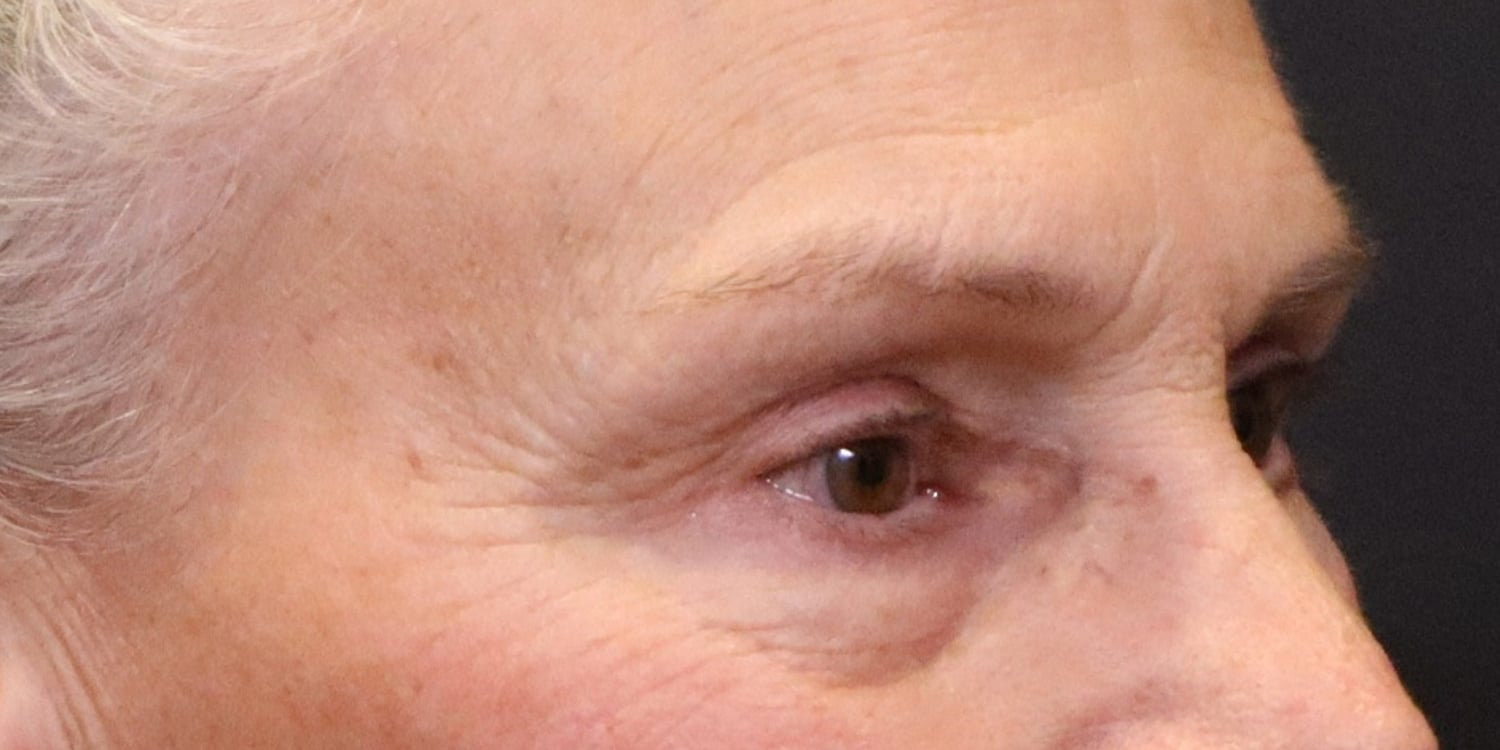 After Image: Blepharoplasty - right-front-oblique