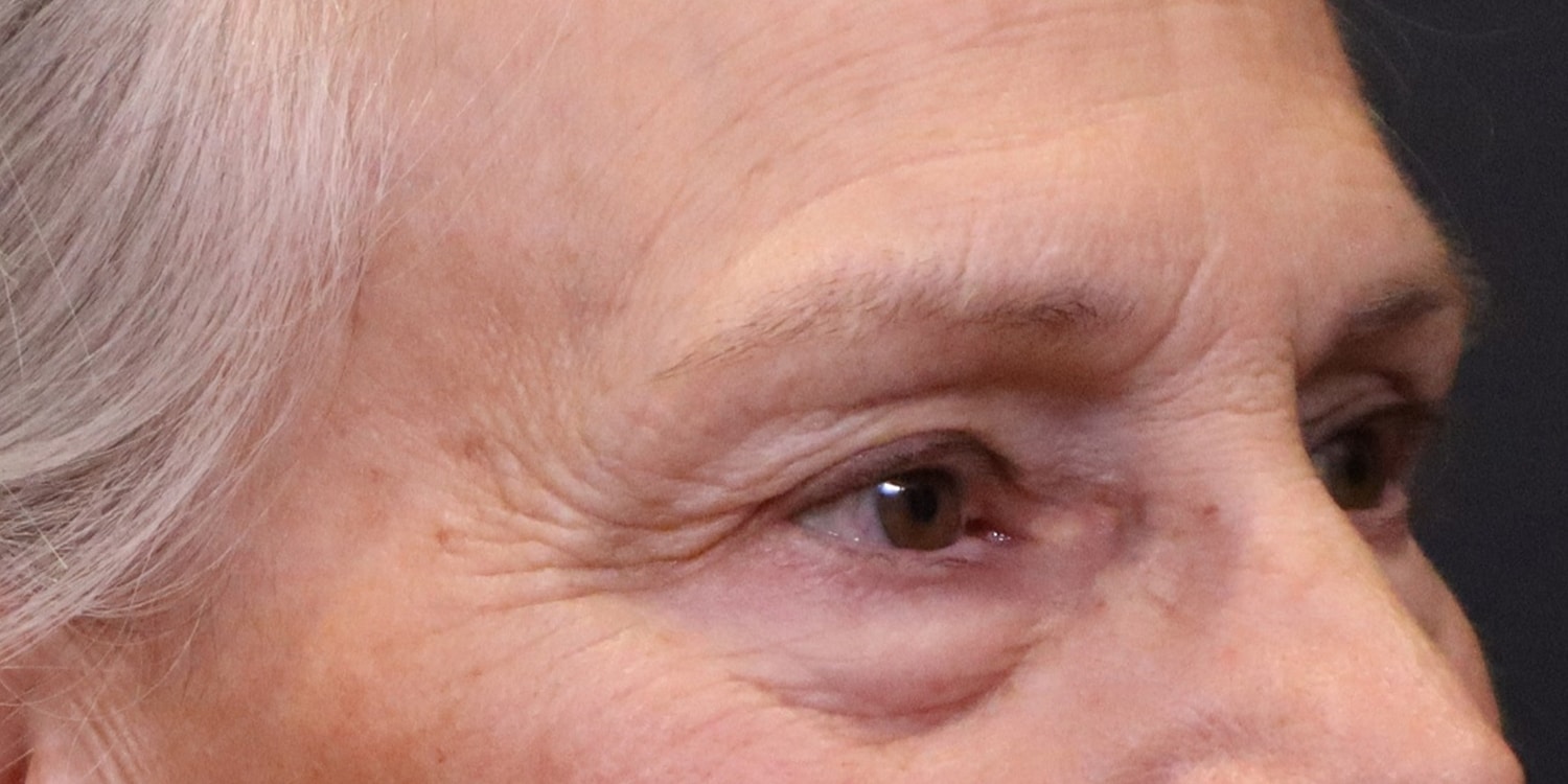 Before Image: Blepharoplasty - right-front-oblique