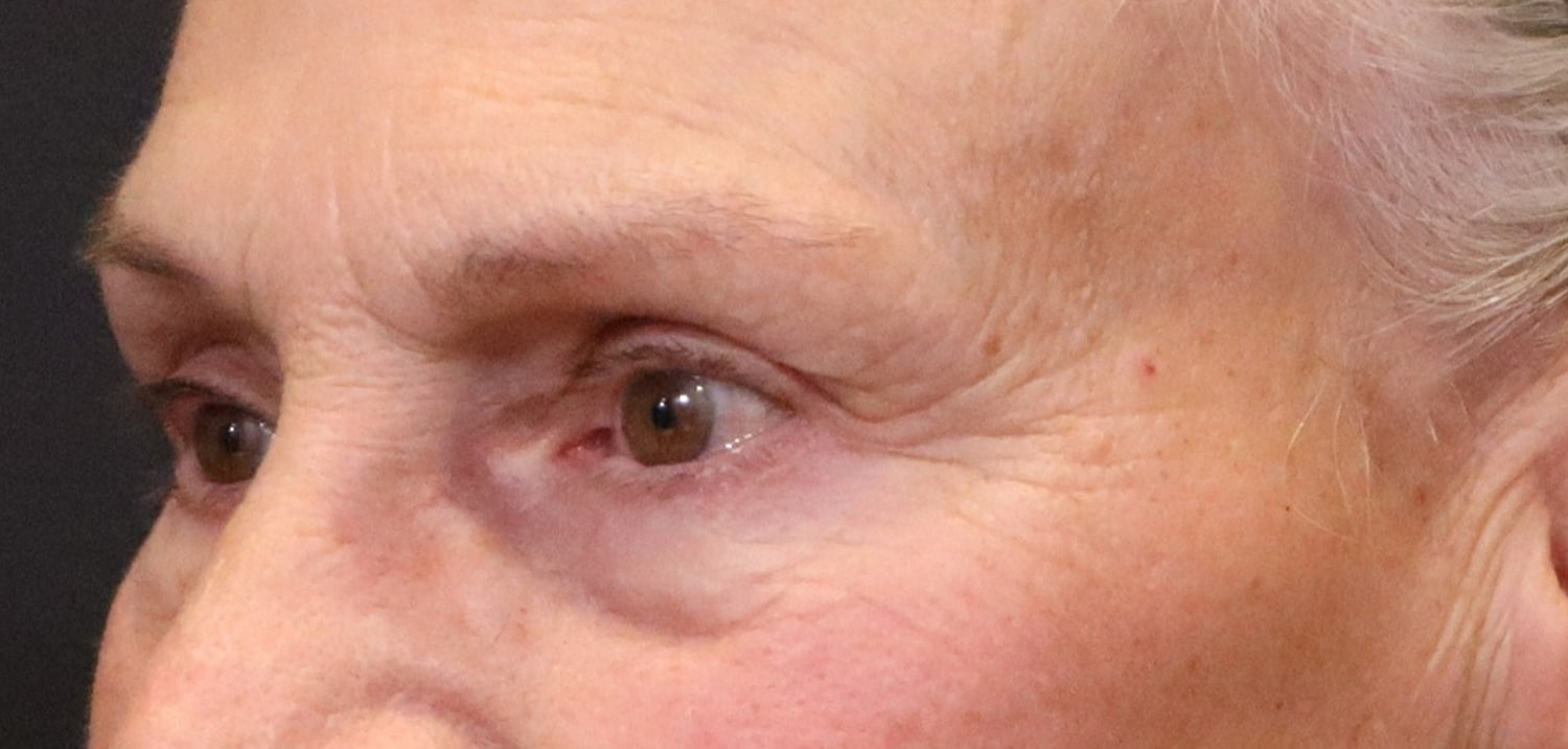 After Image: Blepharoplasty - left-front-oblique