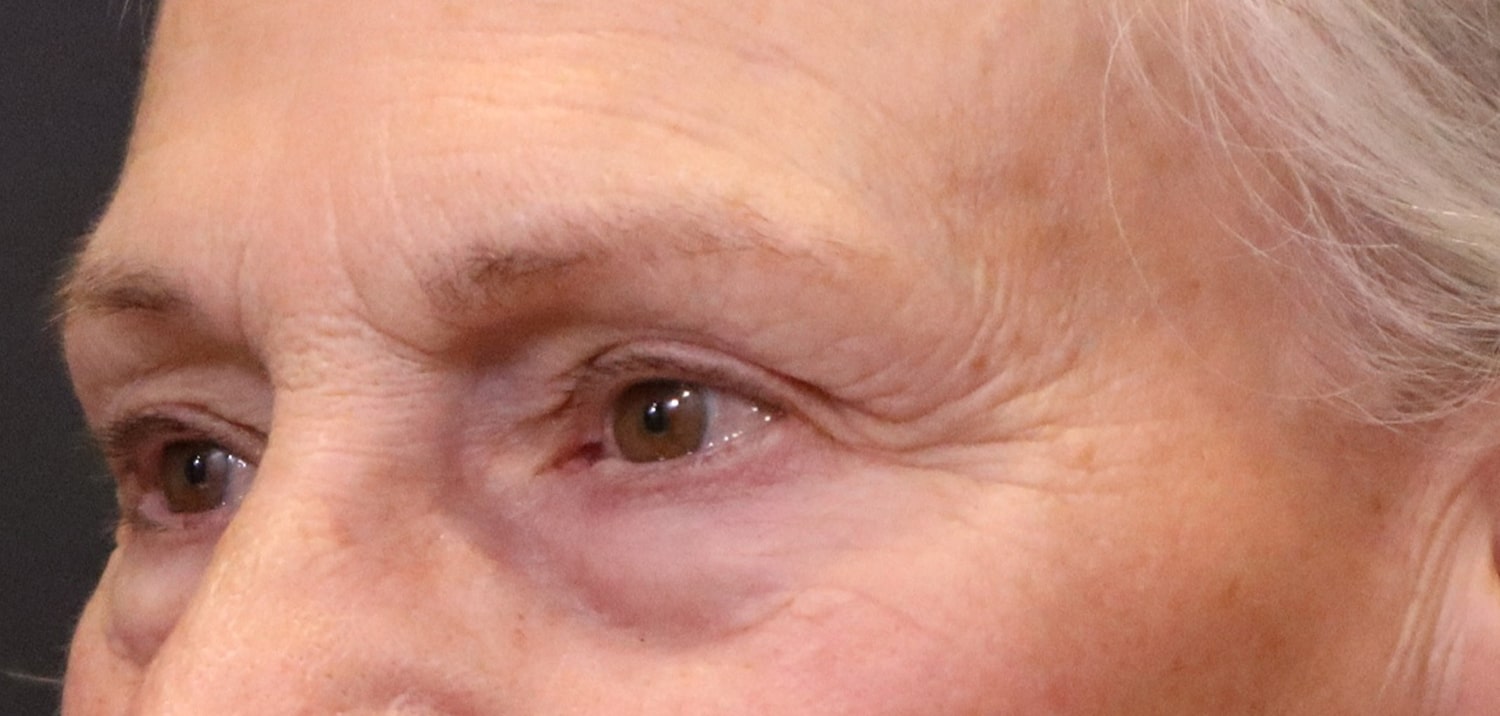 Before Image: Blepharoplasty - left-front-oblique