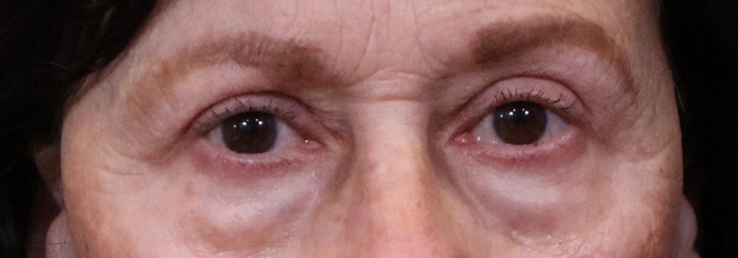 After Image: Blepharoplasty - front