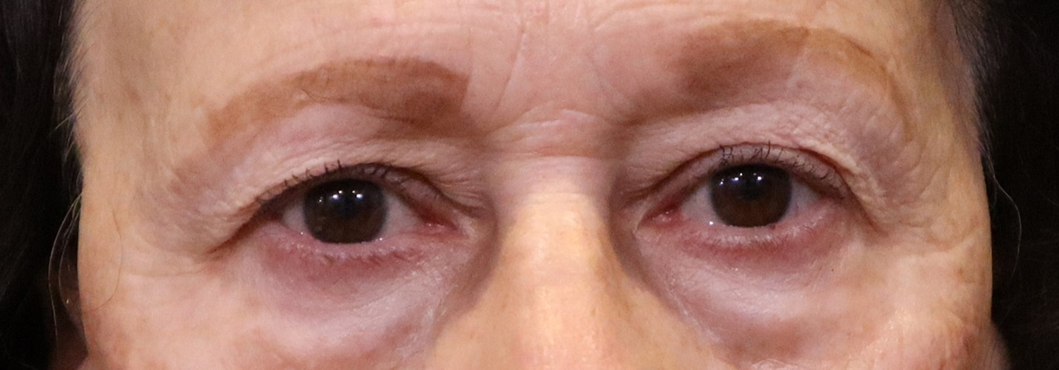 Before Image: Blepharoplasty - front