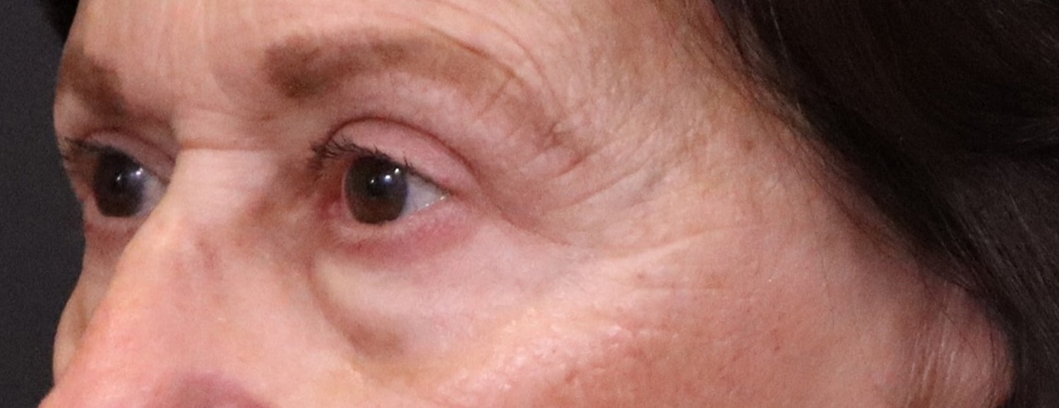 After Image: Blepharoplasty - left-front-oblique