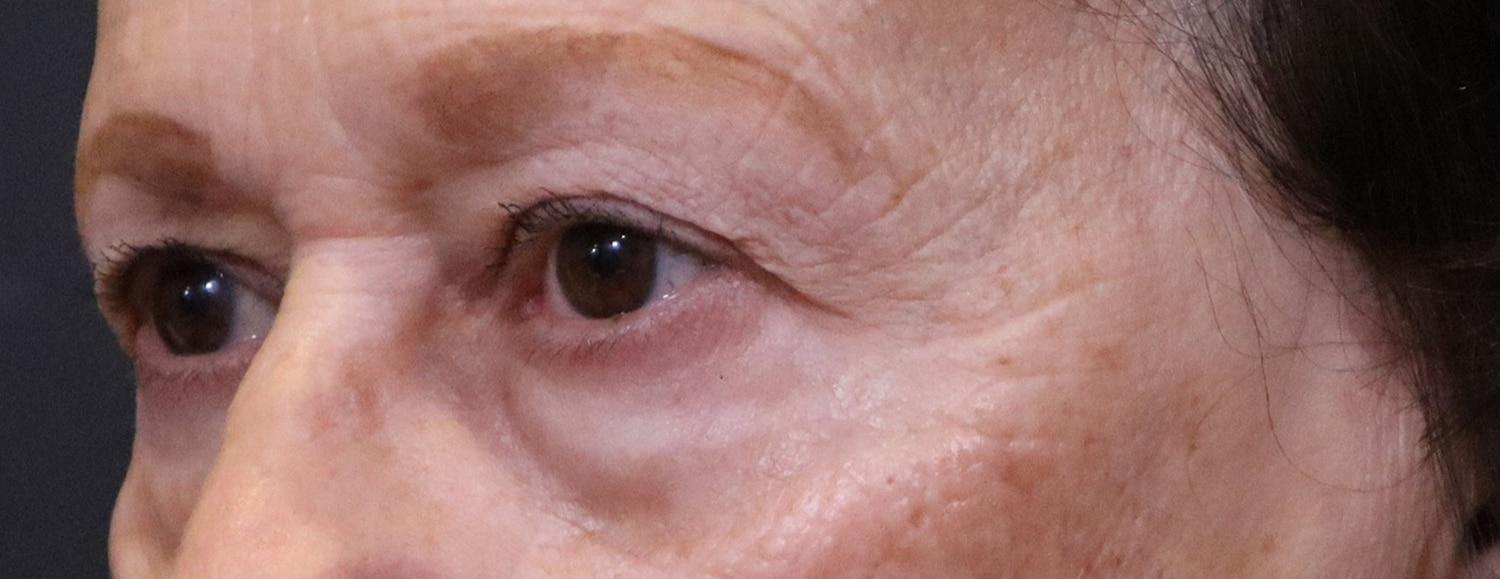 Before Image: Blepharoplasty - left-front-oblique